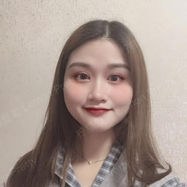 这个女孩的切开重睑术已经完全恢复好了,目前的反馈非常好.