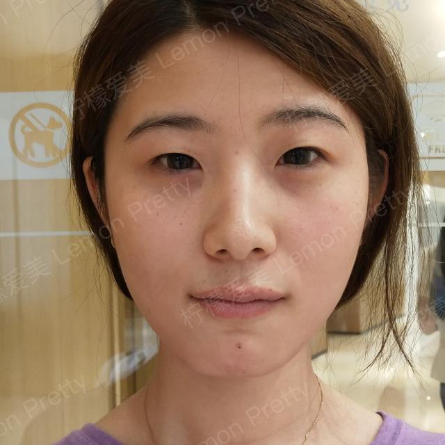 双眼皮中真性肉条和假性肉条的区别