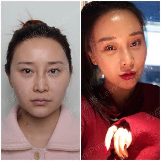 面部光纤溶脂,脸小一圈!
