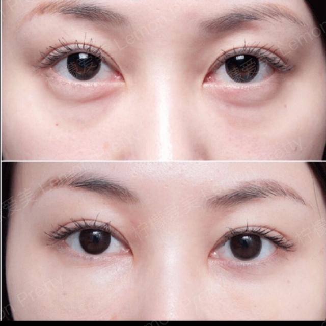 割眼袋失败怎么办?