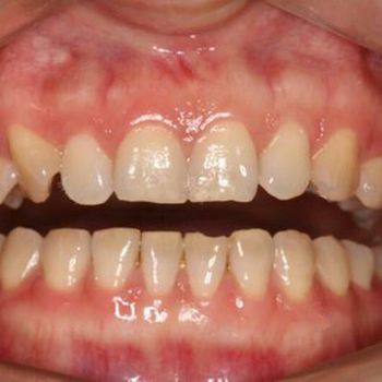 给牙齿戴个帽子太重要,做完根管治疗为啥一定要戴冠?