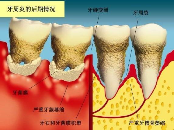 你好医生请问镶牙用拔牙根吗?