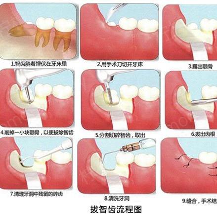 智齿一定要拔吗