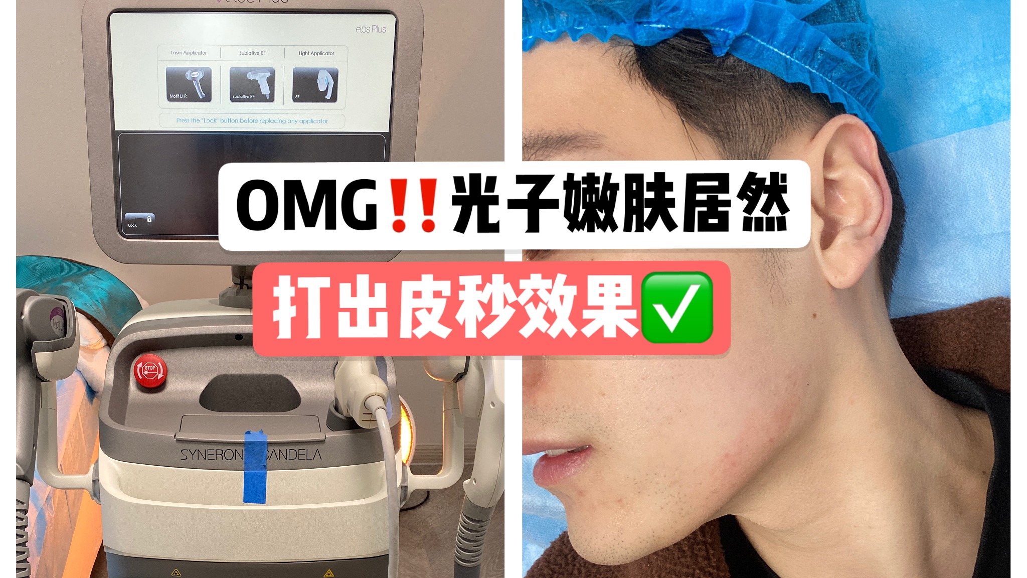 激光祛斑治疗痛不痛?